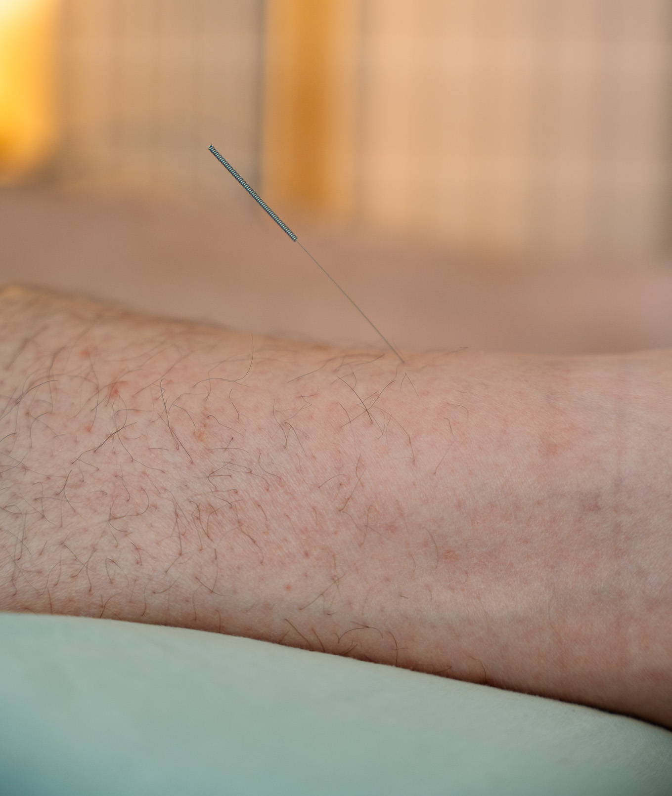 The Healing Connection Between Acupuncture and Eczema: A General Overview