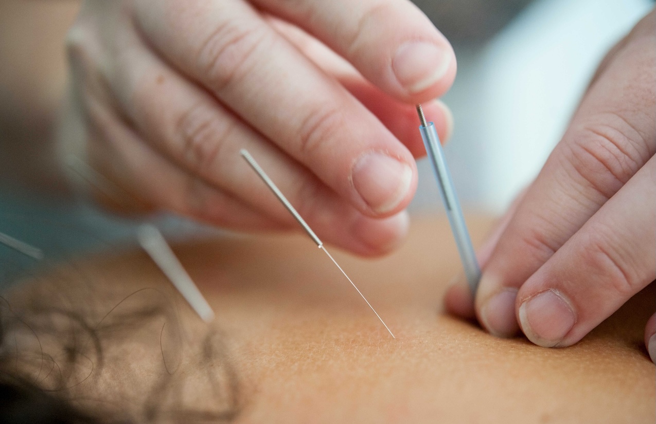 The Healing Connection Between Acupuncture and Eczema: A General Overview