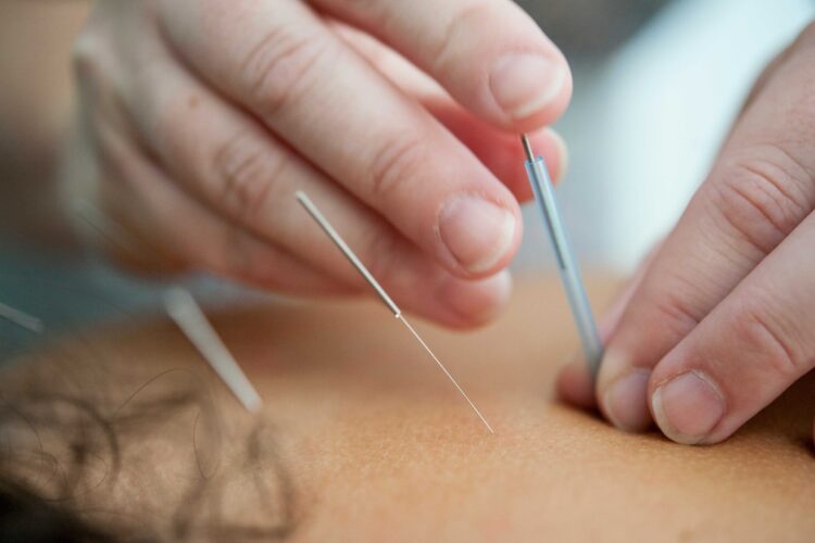 The Healing Connection Between Acupuncture and Eczema: A General Overview